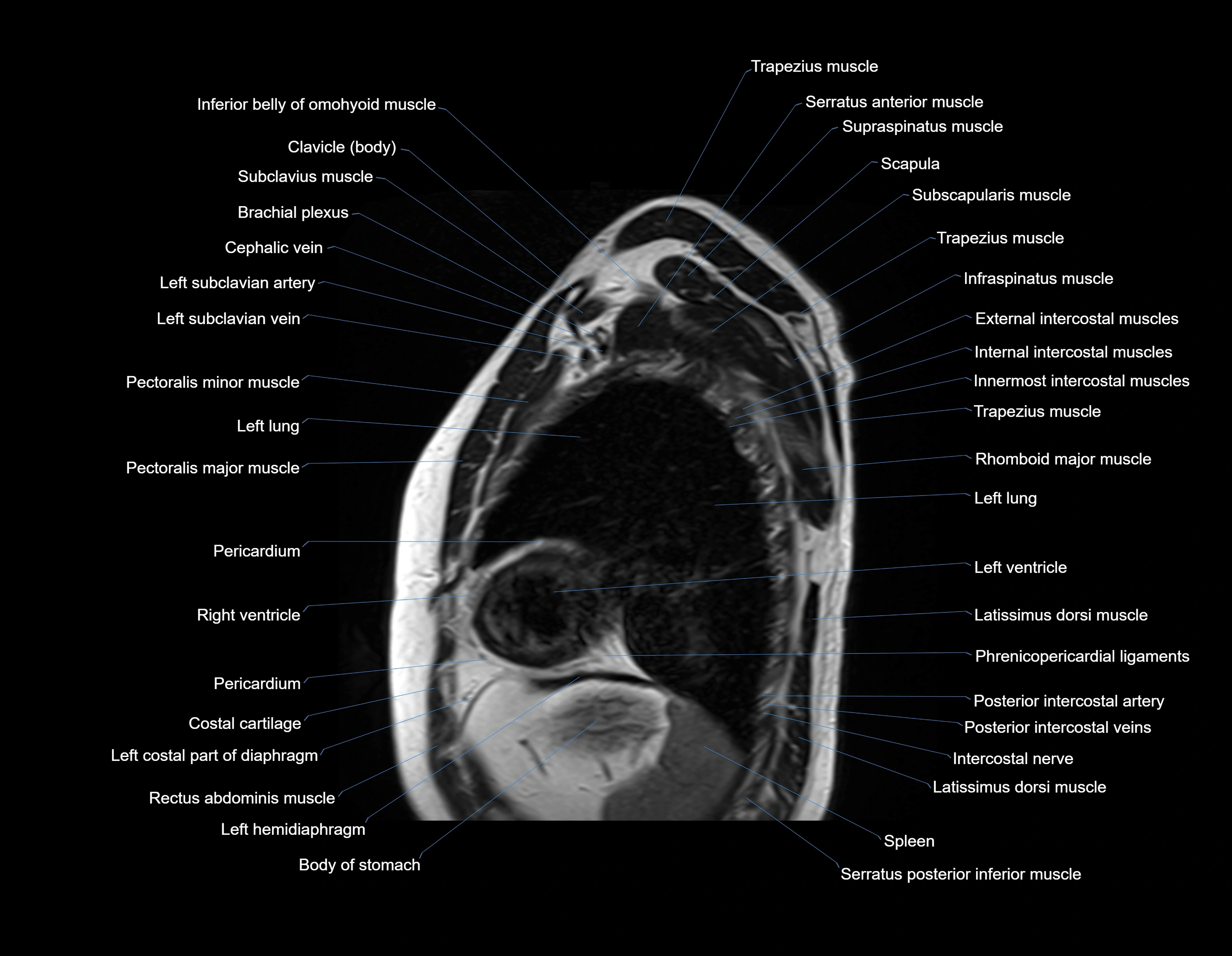 MRI chest (thorax) sagittal labelled cross sectional anatomy 3T radiology image-img-00001-00030.webp